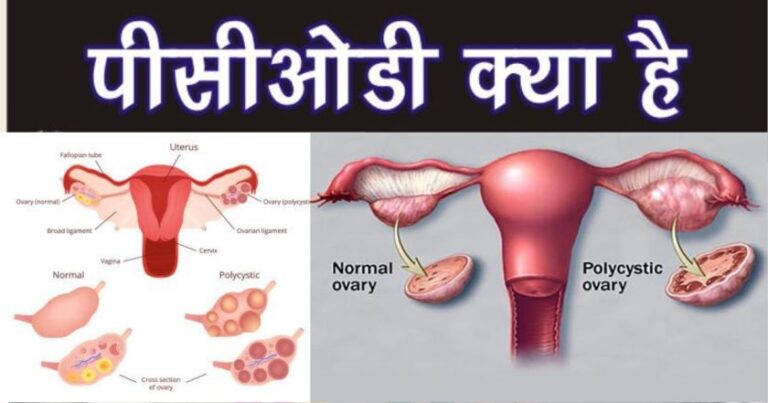 पीसीओडी क्या है ?